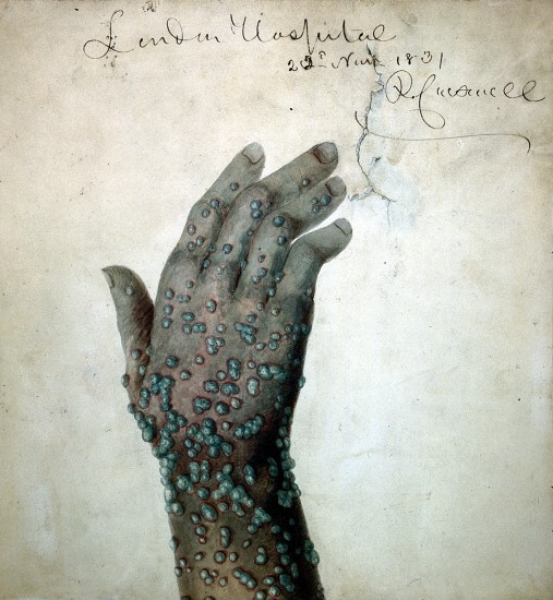 L0019716 Green Smallpox-pustules by Carswell. Credit: Wellcome Library, London. Wellcome Images images@wellcome.ac.uk http://wellcomeimages.org A hand and wrist with green smallpox-pustules. Signed and dated 'London Hospital 22 Nov [?] 1831 R. Carswell'. Watercolour 3e/12/1831 By: Robert CarswellPublished: 1831. Copyrighted work available under Creative Commons by-nc 2.0 UK, see http://wellcomeimages.org/indexplus/page/Prices.html